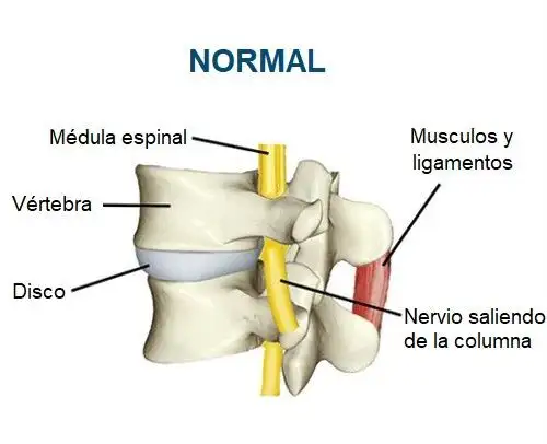 Columna vertebral Dolor de espalda