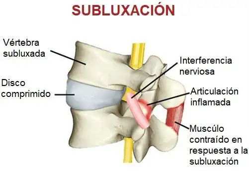 Dolor de espalda subluxacion
